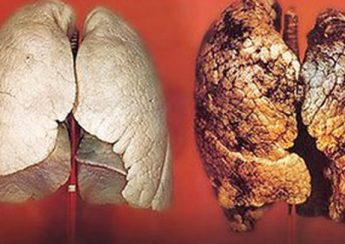 tìm hiểu bệnh ung thư phổi